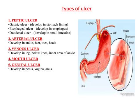 Presentation on peptic ulcer | PPTX