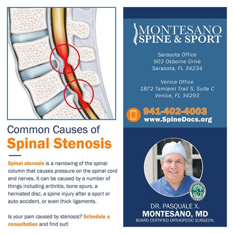 Common Causes of Spinal Stenosis - Spine Docs