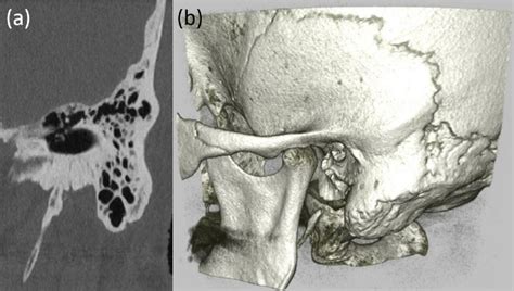 Image result for Temporal Bone Mastoid Process