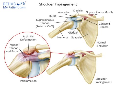 Shoulder Impingement Syndrome | Rehab My Patient