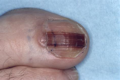 Folds in Hutchinson's Nail Sign Provide Useful Clinical Information in ...