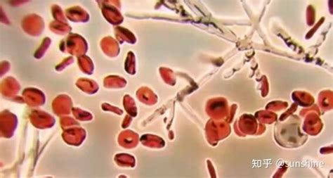 CDC最近因为耳念珠菌（又称为超级真菌）感染人数激增，特别发出警告。 - YouTube