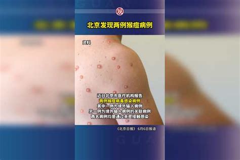 北京发现两例猴痘病例