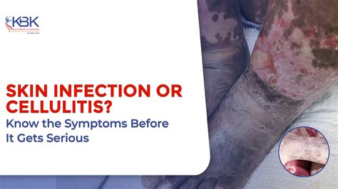 Understanding what is a Chronic skin ulcer? Best treatment & cure