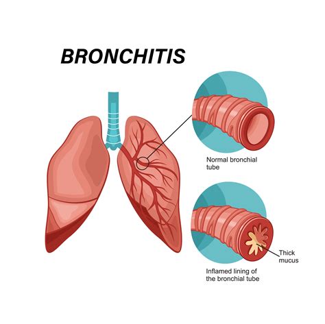 Acute Bronchitis Steroids at Marilyn Stumpf blog