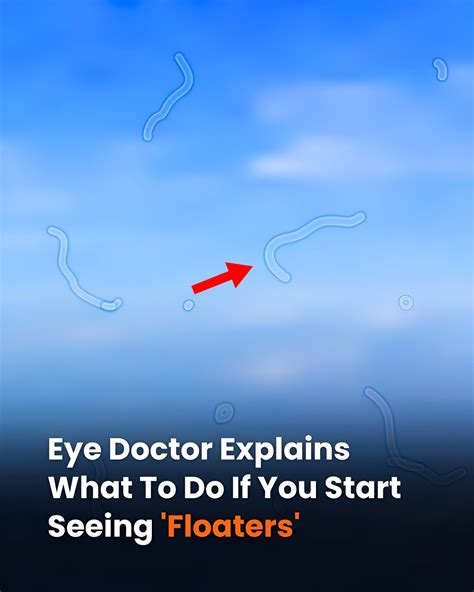 What Are Eye Floaters? Here What To Do If you Start Seeing Them - Usa Press