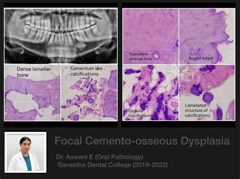 Focal COD — ORAL PATHOLOGY-SAVEETHA