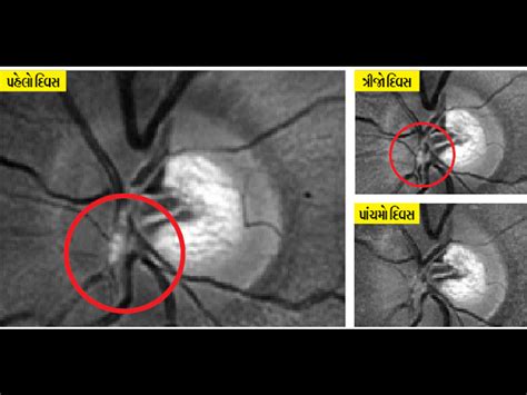 Eyes also strip the corona, the corona forms blood clots in the body ...