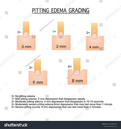 Pitting Edema