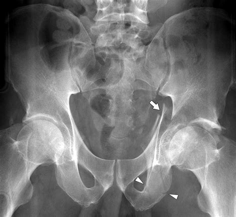 What Is A Radiographic Imaging To Characterize A Acetabular Fracture at Hunter Lilley blog