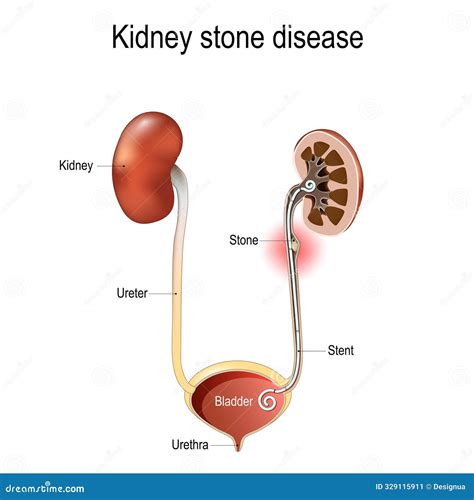 Kidney Stone Disease. Cross Section of Ureter with Stone and Stent Stock Vector - Illustration ...