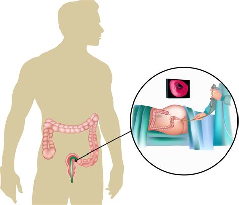Sigmoidoscopy | Colon Examination | Call today to schedule