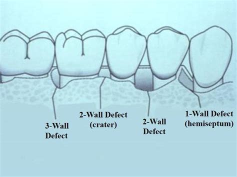 Image result for Two Walled Defect Perio