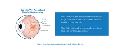WAMD - Wet Age Related Macular Degeneration - Kodiak Sciences