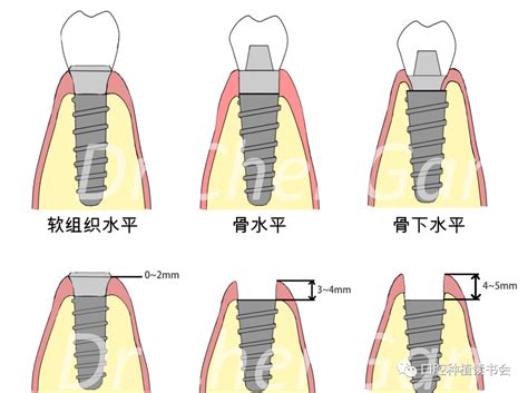 在北京种植一颗牙齿需要多少钱,5000或8000还是一两万元呢,种植牙-8682赴韩整形网