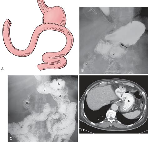 Postoperative Stomach and Duodenum - Clinical Tree