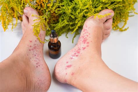 Itchy Feet: Causes and Prevention – Drfootin