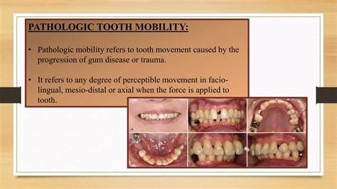 Classification Of Dental Mobility at Jasper Saranealis blog