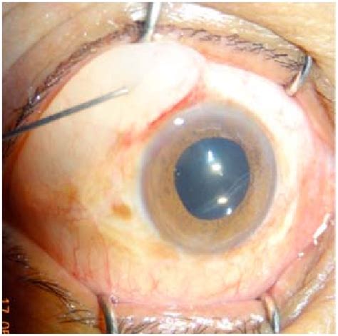 Subconjunctival Injection 的图像结果