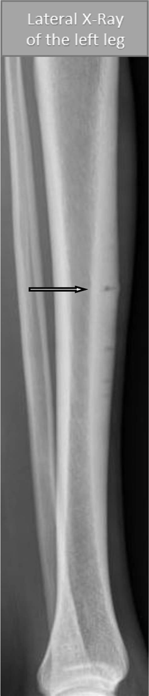 Stress Fracture Tibia Bone Scan