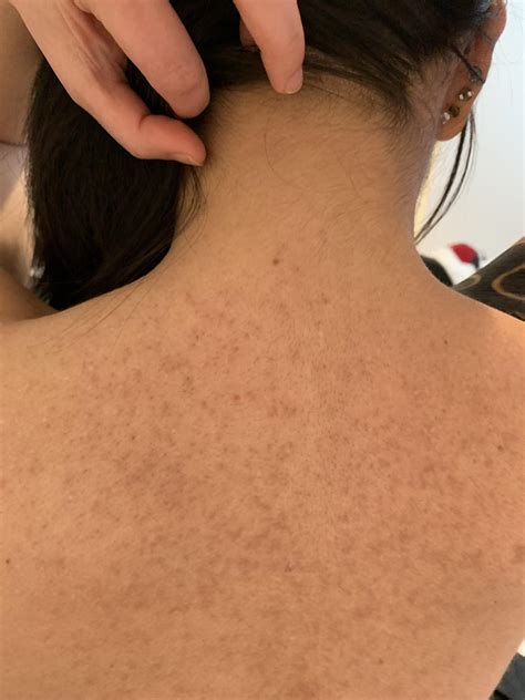 Keratosis pilaris discoloration (w/ pic) : r/keratosis