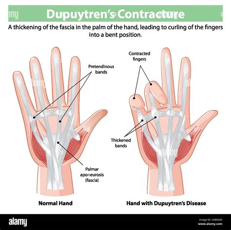 Image result for Normal Hand