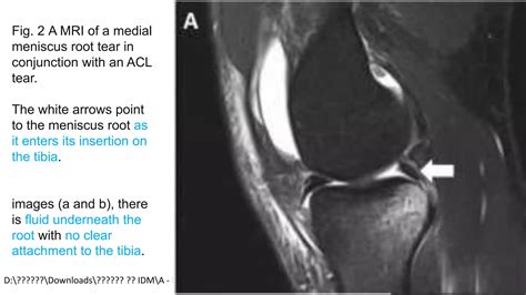 Meniscus Meniscal Root Ligament Lesions, MRI of PMMRL tears posterior horn of the medial ...