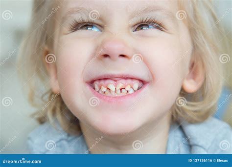 Boy. Bad teeth. stock photo. Image of cavity, healthy - 137136116