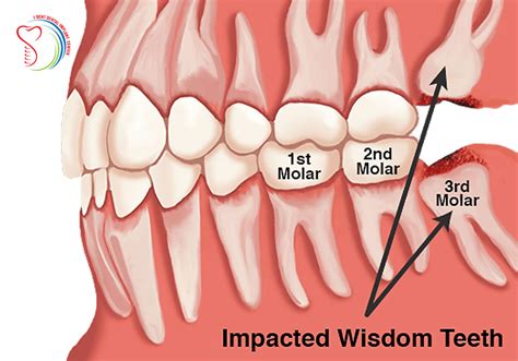 Wisdom Teeth Function 的图像结果