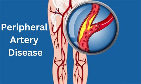 Apelin promising therapy for diabetes patients with peripheral arterial ...