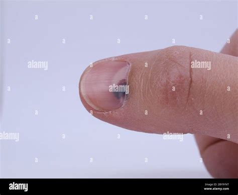 Nail Hematoma Pictures at Ella Byatt blog