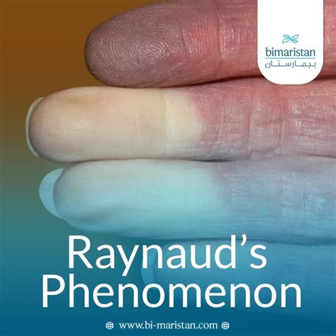 Raynaud's phenomenon: Causes, symptoms, treatment and prevention - بيمارستان