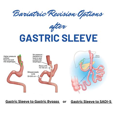 gastric bypass surgery revision, surgical options - Revision options a...