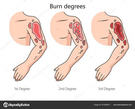 3rd Degree Burn Diagram