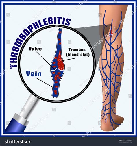Thrombophlebitis Blood Clots Veins Embolism Thrombosis Stock Vector ...