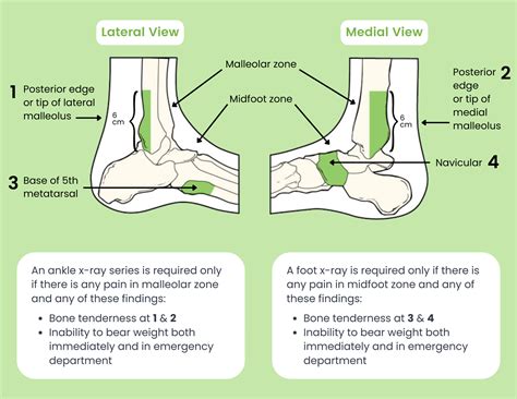 The Ottawa Ankle Rules — ChiroUp