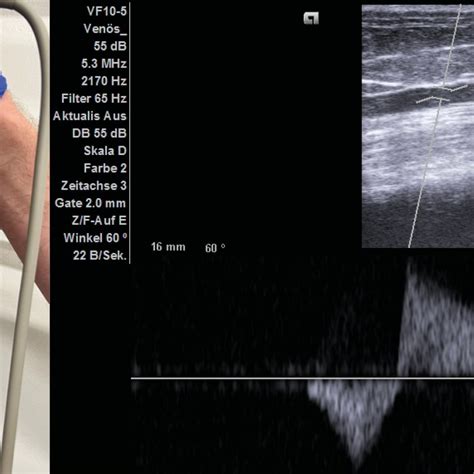 Endovenöse Thermoablation bei Krampfadernerkrankungen - Dermatologie ...