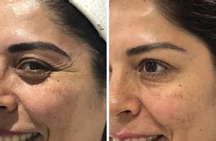 Skin Care | Hair Treatment | Laser Clinic in Bangalore - Glow Up