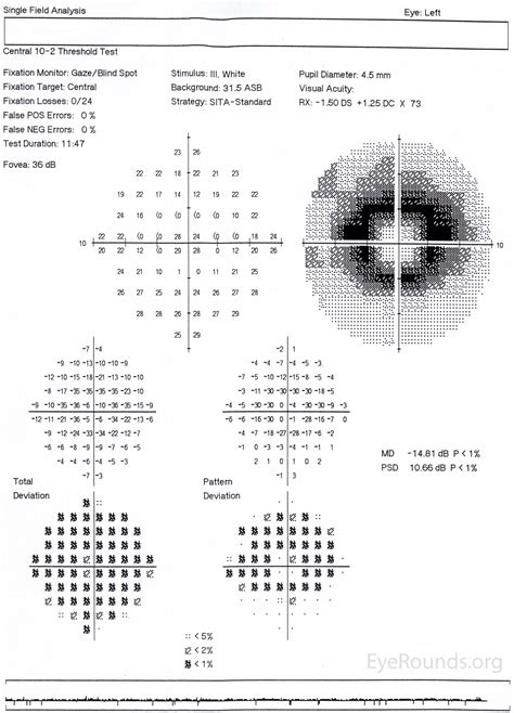 Bull's-eye maculopathy due to hydroxychloroquine toxicity