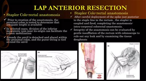 Image result for Apr Resection Surgery