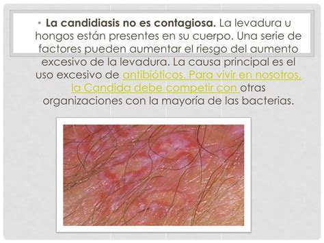 Ulceras Genitales Por Candidiasis - RETOEDU