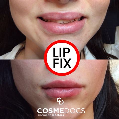 Bad Lip Injections Before And After