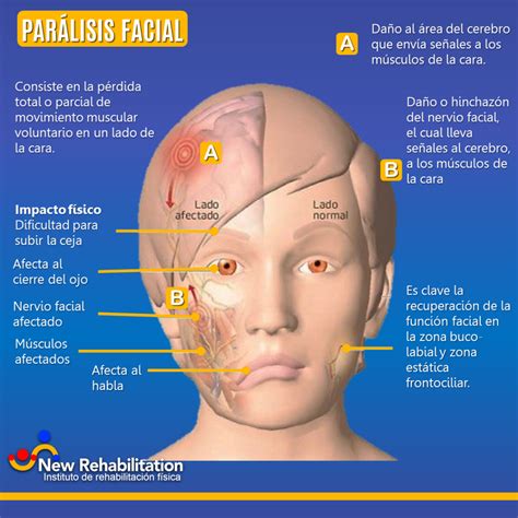 Parálisis facial, sus diferentes tipos y cómo recuperarte | NewRehabilitation