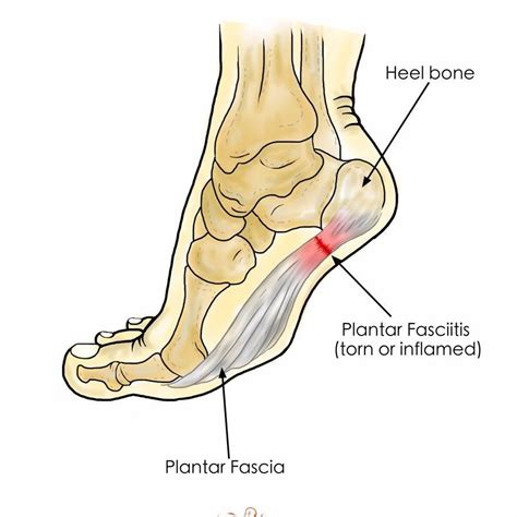 Plantar Fasciitis 的图像结果