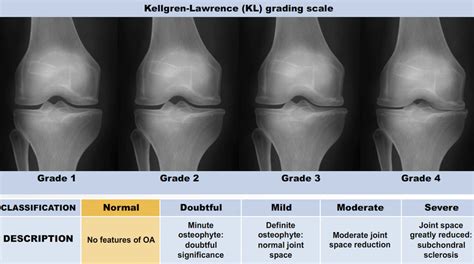 The Kellgren and Lawrence grading system to assess the severity of knee ...