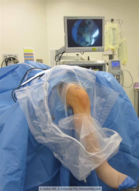 Arthroscopic Lateral Release of the Knee - OrthopaedicsOne Articles - OrthopaedicsOne