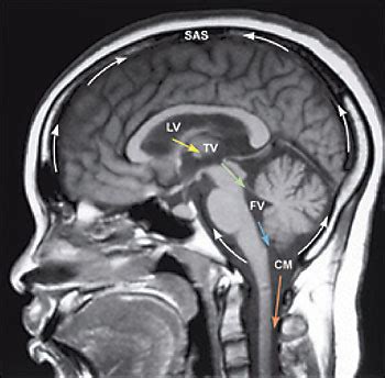 CSF Flow MRI 的图像结果
