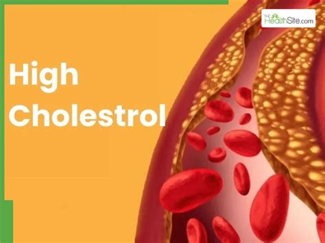 High Cholesterol Symptoms: 5 Warning Signs You May Notice in Your Hands ...