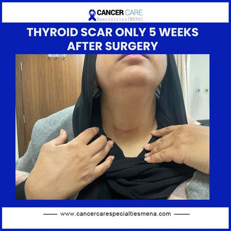 Thyroid scar only 5 weeks after surgery | Cancer Care Center UAE