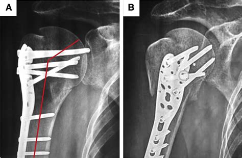 Humerus Fracture Plates Screws at Glenn Thacker blog